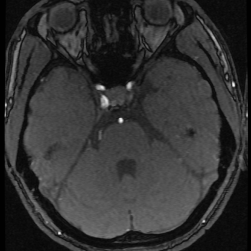 Azygos anterior cerebral artery (Radiopaedia 17059-16756 Axial MRA 56).jpg
