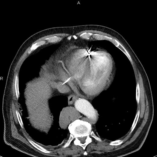 File:Azygos continuation of the inferior vena cava (Radiopaedia 18537-18404 C+ arterial phase 42).jpg