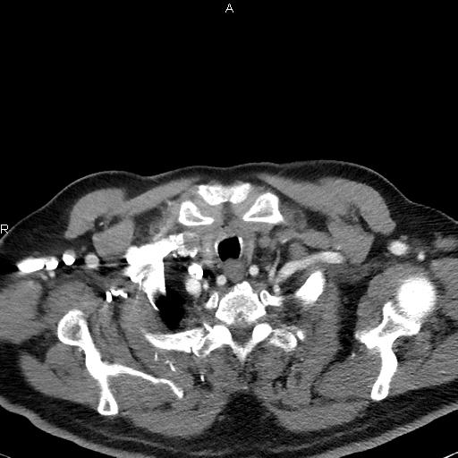 File:Azygos continuation of the inferior vena cava (Radiopaedia 18537-18404 C+ arterial phase 7).jpg