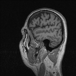 Balo concentric sclerosis (Radiopaedia 50458-55940 Sagittal T1 35).jpg