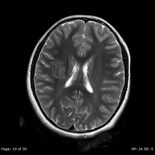 File:Balo concentric sclerosis (Radiopaedia 61637-69636 Axial T2 19).jpg