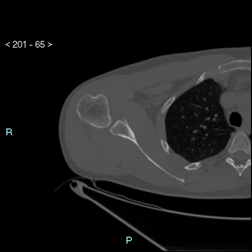 Bankart lesion with glenoid bone defect - assessment TC with PICO method (Radiopaedia 42855-93901 Axial bone window 64).jpg
