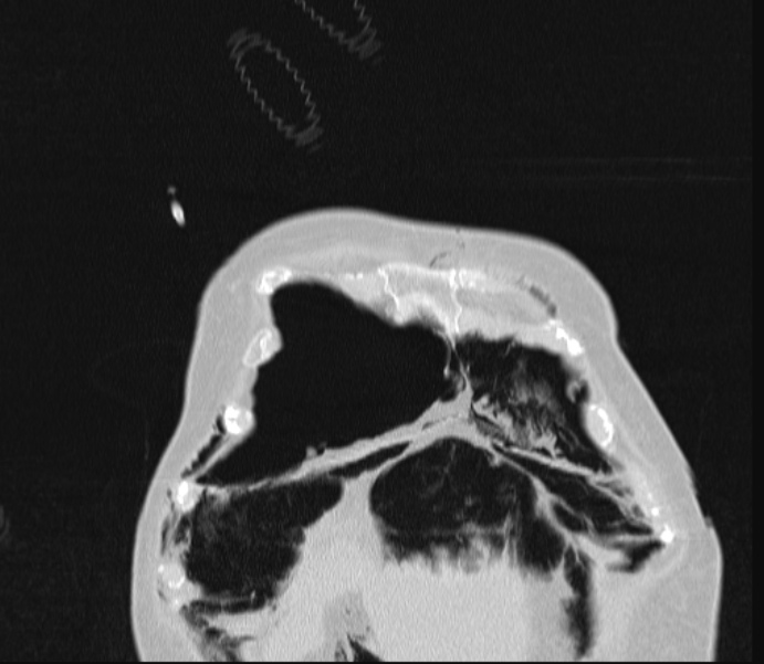 Barotrauma due to mechanical ventilation (Radiopaedia 28079-28336 Coronal lung window 13).jpg