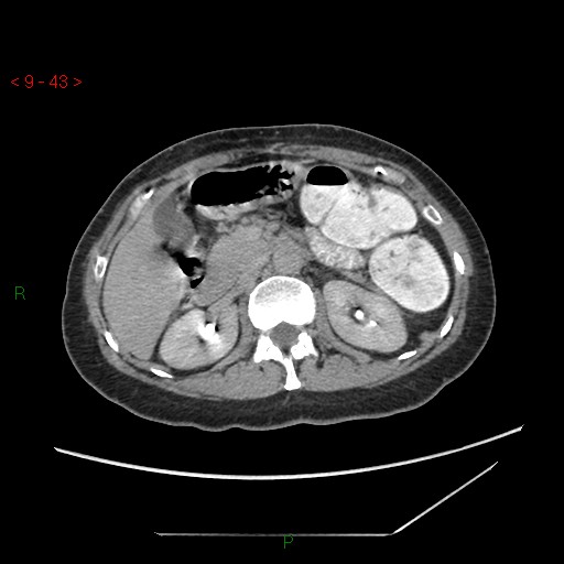 File:Bartholin gland cyst (Radiopaedia 54904-61181 Axial C+ delayed 11).jpg