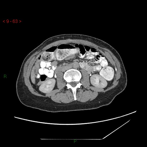 File:Bartholin gland cyst (Radiopaedia 54904-61181 Axial C+ delayed 16).jpg