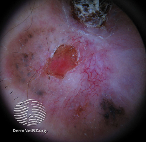 File:Basal cell carcinoma affecting the face (DermNet NZ lesions-bcc-face-0677).jpg