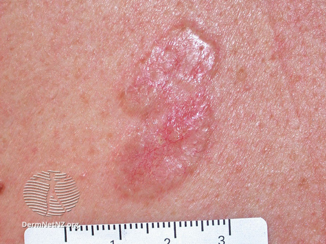 File:Basal cell carcinoma affecting the trunk (DermNet NZ lesions-bcc-trunk-1015).jpg