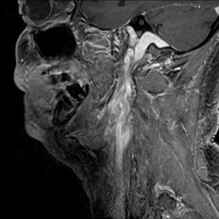 Base of tongue squamous cell carcinoma (Radiopaedia 31174-31884 F 127).jpg