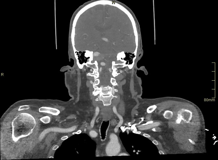 Basilar artery aneurysm (Radiopaedia 56261-62932 B 32).jpg
