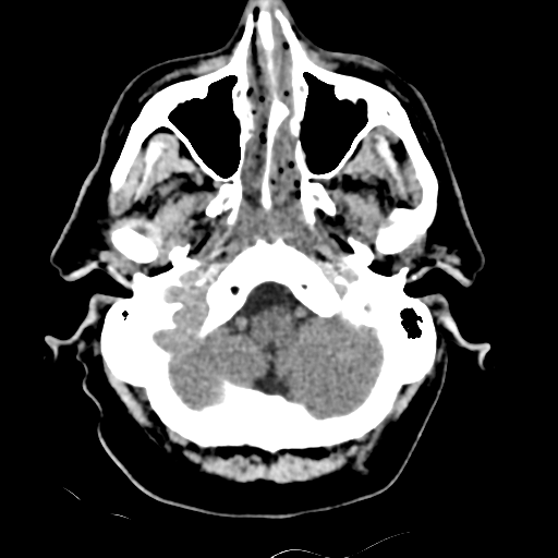 File:Basilar artery occlusion (Radiopaedia 33570-34659 Axial non-contrast 8).png