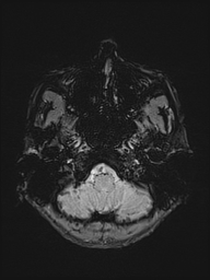 Basilar artery perforator aneurysm (Radiopaedia 82455-97733 Axial SWI 4).jpg