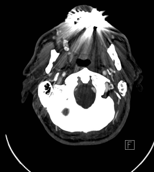 Basilar artery thrombosis (Radiopaedia 26986-27163 A 10).jpg