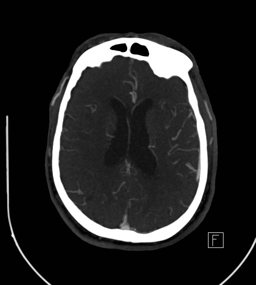 Basilar artery thrombosis (Radiopaedia 26986-27163 A 56).jpg