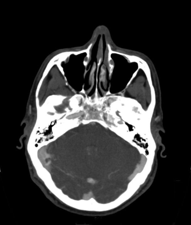 Basilar artery thrombosis and ascending transtentorial herniation (Radiopaedia 84759-100360 B 45).jpg