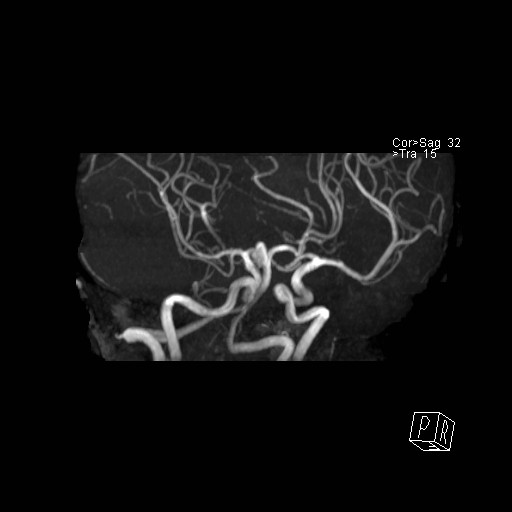 Basilar tip aneurysm (Radiopaedia 26504-26632 D 43).jpg