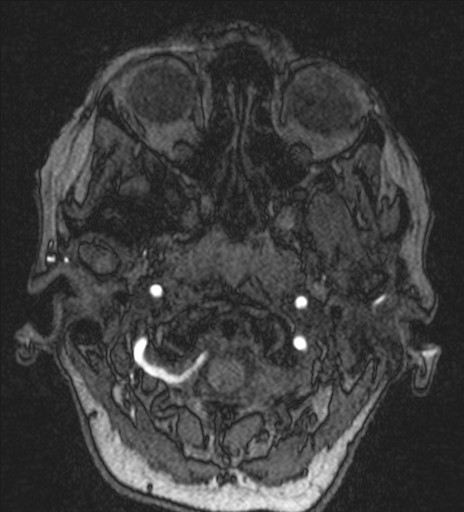 Basilar tip aneurysm (Radiopaedia 26504-26632 MRA 12).jpg