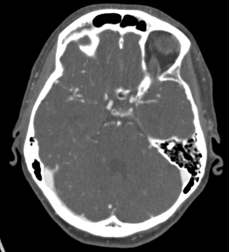 File:Basilar tip aneurysm with coiling (Radiopaedia 53912-60086 A 51).jpg