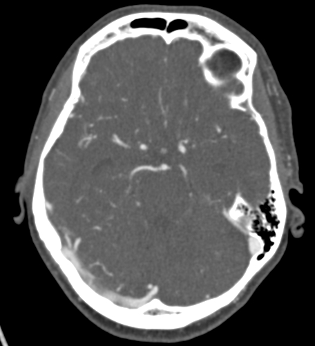 File:Basilar tip aneurysm with coiling (Radiopaedia 53912-60086 A 55).jpg