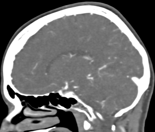 File:Basilar tip aneurysm with coiling (Radiopaedia 53912-60086 C 54).jpg