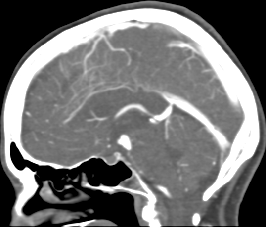 Basilar tip aneurysm with coiling (Radiopaedia 53912-60086 C 68).jpg