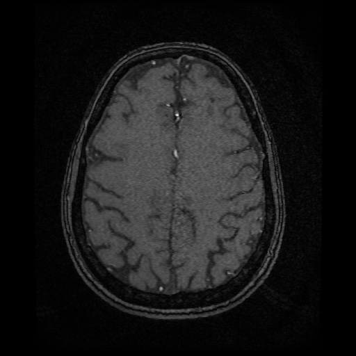 Basilar top and left middle cerebral artery aneurysm (Radiopaedia 61965-70031 Axial MRA 126).jpg
