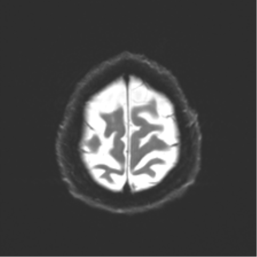 Behavioral variant frontotemporal dementia and late onset schizophrenia (Radiopaedia 52197-58083 Axial DTI Trace W 24).png