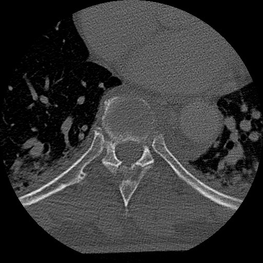 Benign post-traumatic pseudopneumoperitoneum (Radiopaedia 71199-81495 Axial bone window 115).jpg