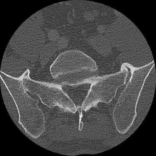 Benign post-traumatic pseudopneumoperitoneum (Radiopaedia 71199-81495 Axial bone window 284).jpg