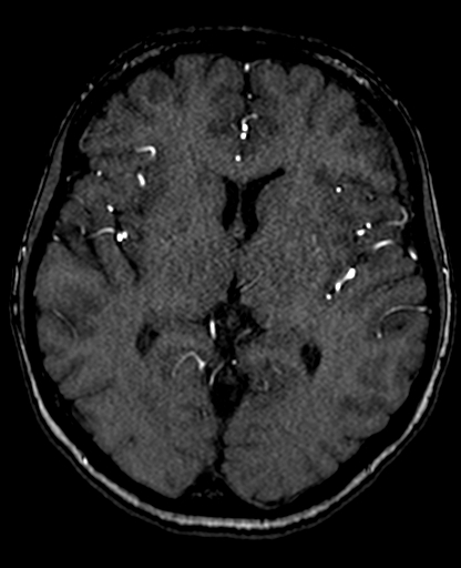 File:Berry aneurysm of the terminal internal carotid artery (Radiopaedia 88286-104918 Axial TOF 128).jpg