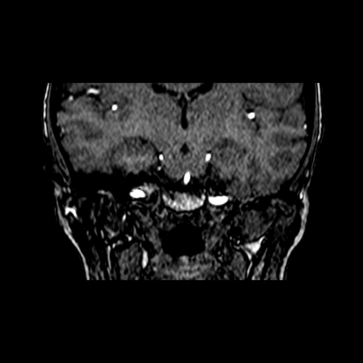 File:Berry aneurysm of the terminal internal carotid artery (Radiopaedia 88286-104918 Coronal TOF 52).jpg