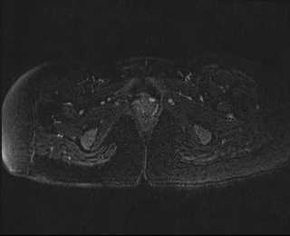 File:Bicornuate bicollis uterus (Radiopaedia 61626-69616 Axial PD fat sat 32).jpg