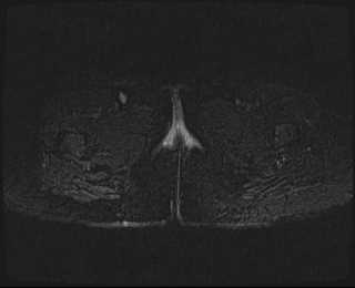 File:Bicornuate bicollis uterus (Radiopaedia 61626-69616 Axial PD fat sat 39).jpg