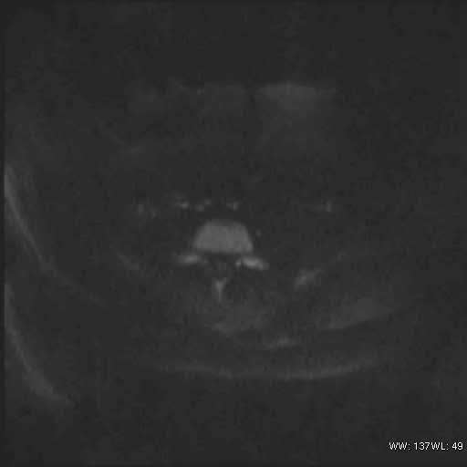File:Bicornuate uterus (MRI) (Radiopaedia 49206-54297 Axial 118).jpg
