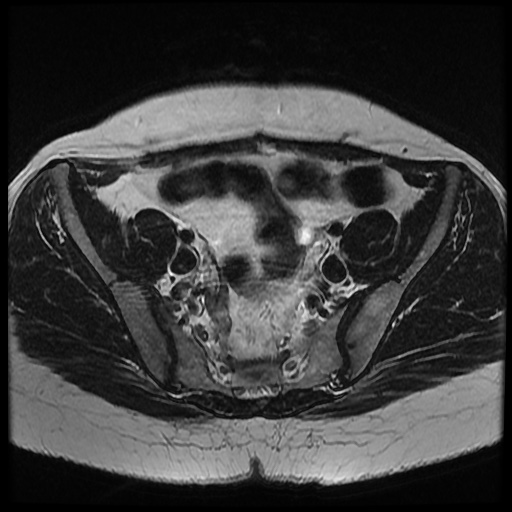 File:Bicornuate uterus (Radiopaedia 51676-57472 Axial T2 24).jpg