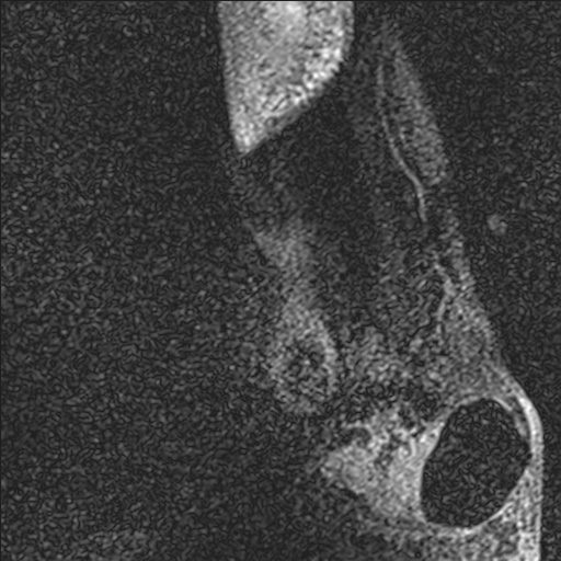 File:Bilateral Achilles tendon complete tear (Radiopaedia 81344-95051 Sagittal WE - Right 1).jpg