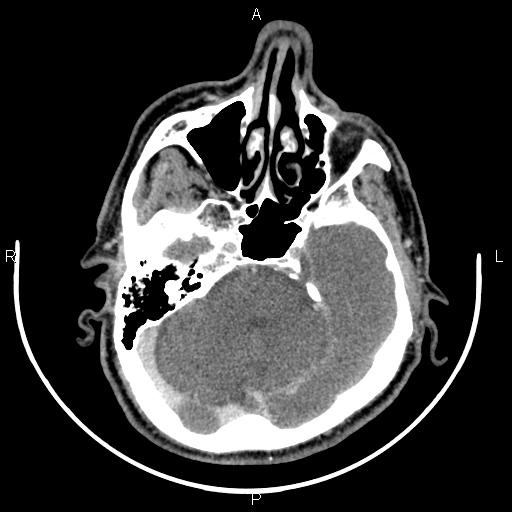 Bilateral Warthin tumors (Radiopaedia 84034-99263 Axial With contrast 4).jpg
