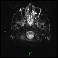File:Bilateral acute middle cerebral artery territory infarcts (Radiopaedia 77319-89402 Axial DWI 3).jpg