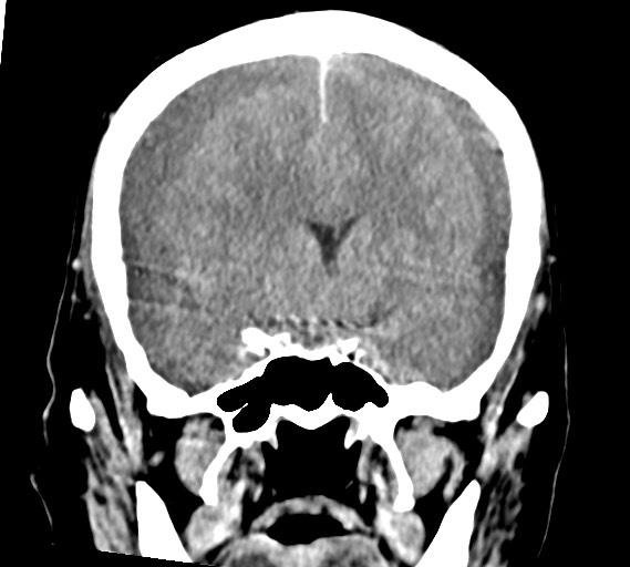 Bilateral acute on chronic subdural hematomas (Radiopaedia 78466-91146 Coronal non-contrast 29).jpg