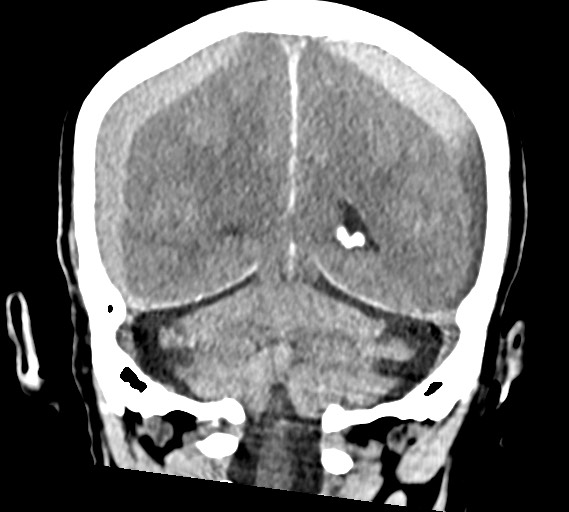 Bilateral acute on chronic subdural hematomas (Radiopaedia 78466-91146 Coronal non-contrast 48).jpg