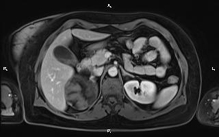 Bilateral adrenal myelolipoma (Radiopaedia 63058-71537 G 38).jpg