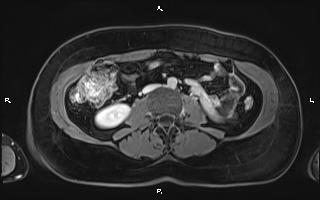 File:Bilateral adrenal myelolipoma (Radiopaedia 63058-71537 H 64).jpg