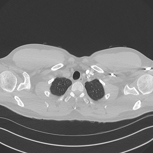 File:Bilateral atelectasis (Radiopaedia 48666-53675 Axial lung window 6).jpg
