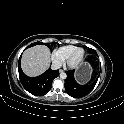 Bilateral benign adrenal adenomas (Radiopaedia 86912-103124 B 13).jpg
