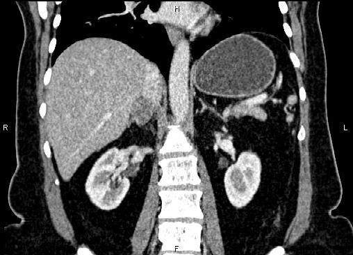 Bilateral benign adrenal adenomas (Radiopaedia 86912-103124 D 37).jpg