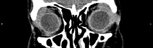 File:Bilateral enlargement of lacrimal glands - sarcoidosis (Radiopaedia 62627-70921 Coronal non-contrast 10).jpg
