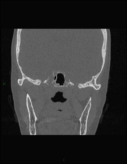 Bilateral frontal mucoceles (Radiopaedia 82352-96454 Coronal 254).jpg