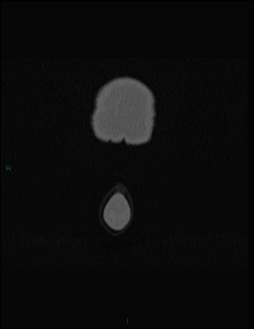 Bilateral frontal mucoceles (Radiopaedia 82352-96454 Coronal 9).jpg