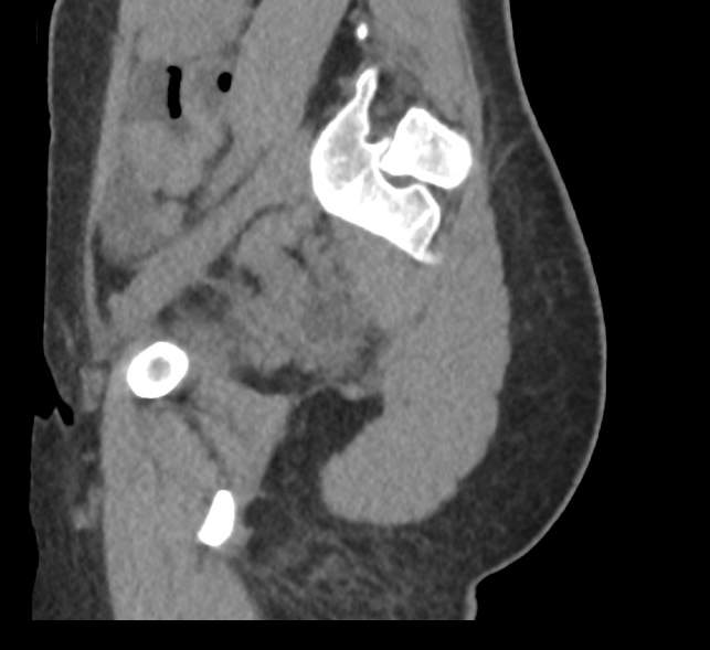 Bilateral mature cystic ovarian teratoma (Radiopaedia 88821-105592 D 55).jpg