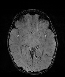Bilateral mesial temporal polymicrogyria (Radiopaedia 76456-88181 Axial SWI 30).jpg
