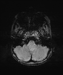 File:Bilateral mesial temporal polymicrogyria (Radiopaedia 76456-88181 Axial SWI 6).jpg
